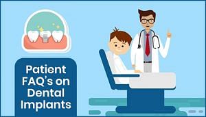 Patient FAQs on Dental Implants