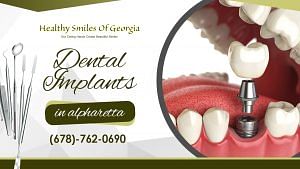 How to take good care of your dental implants in Alpharetta?